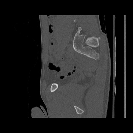 Normal pelvis (Radiopaedia 51473-57238 Sagittal bone window 55).jpg
