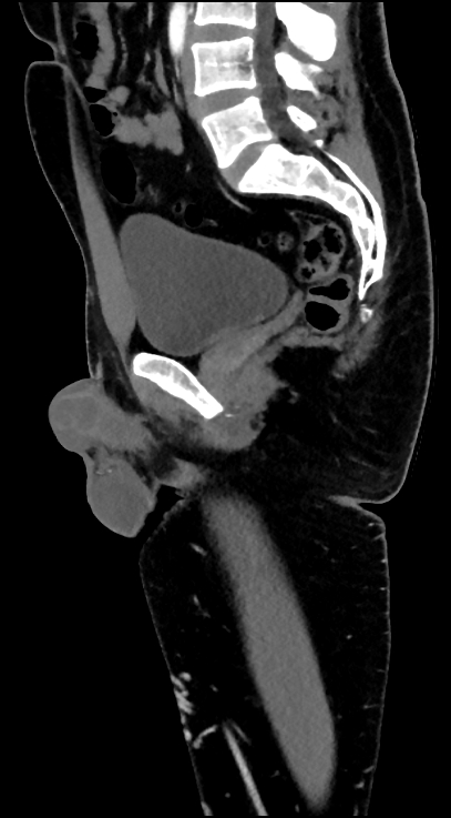 Normal pelvis CT angiogram (Radiopaedia 84966-100481 C 58).jpg
