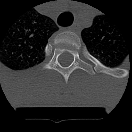 Normal trauma spine imaging (age 16) (Radiopaedia 45335-49358 Axial bone window 87).jpg