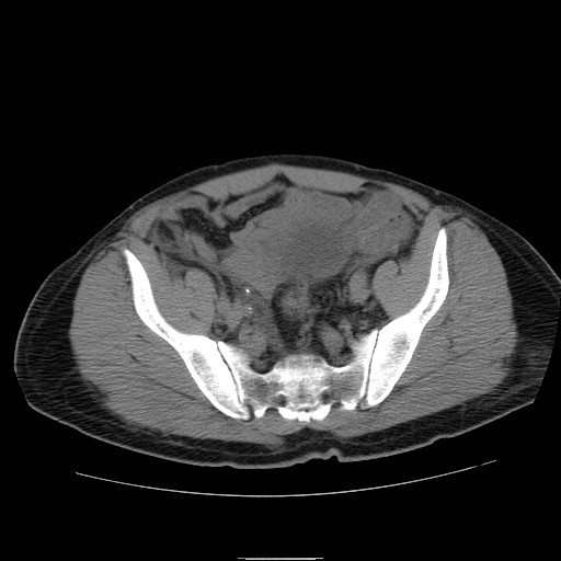 File:Obstructed kidney with perinephric urinoma (Radiopaedia 26889-27066 Axial non-contrast 53).jpg