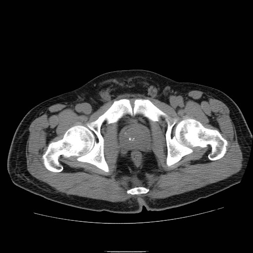 File:Obstructed kidney with perinephric urinoma (Radiopaedia 26889-27066 Axial non-contrast 63).jpg