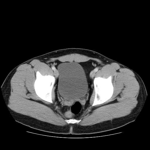 File:Obstructing ureteric calculus (Radiopaedia 18615-18514 B 51).jpg