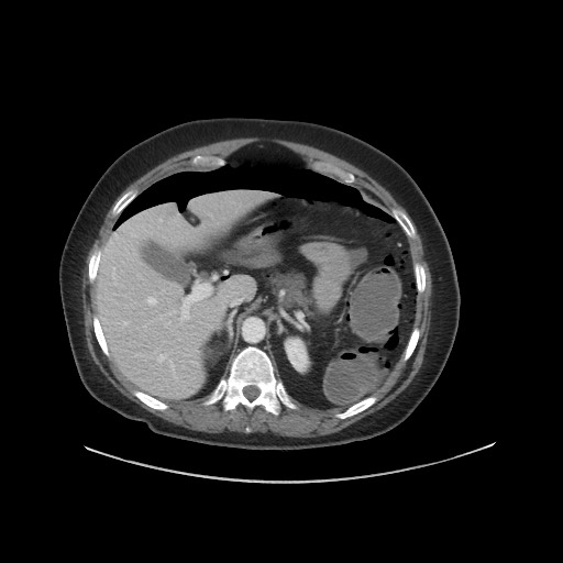 Obstructive distal colonic adenocarcinoma causing cecal perforation (Radiopaedia 86830-102989 A 54).jpg