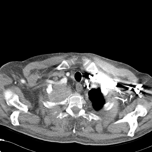 File:Obstructive superior vena cava tumor thrombus (Radiopaedia 28046-28306 A 5).jpg