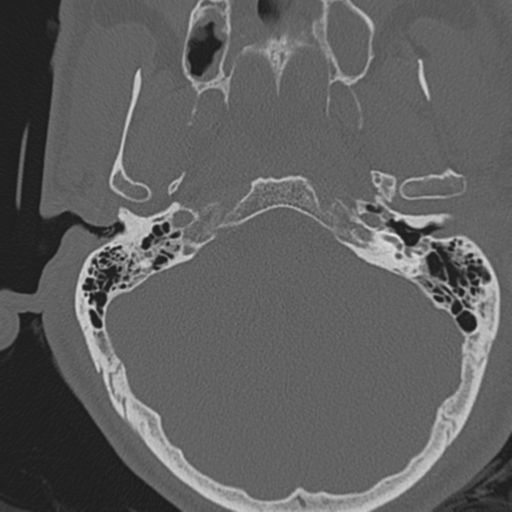 File:Occipital condyle fracture (Radiopaedia 33467-34517 Axial bone window 3).png