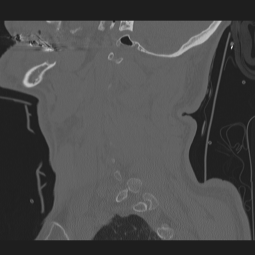 File:Occipital condyle fracture (Radiopaedia 33467-34517 Sagittal bone window 14).png