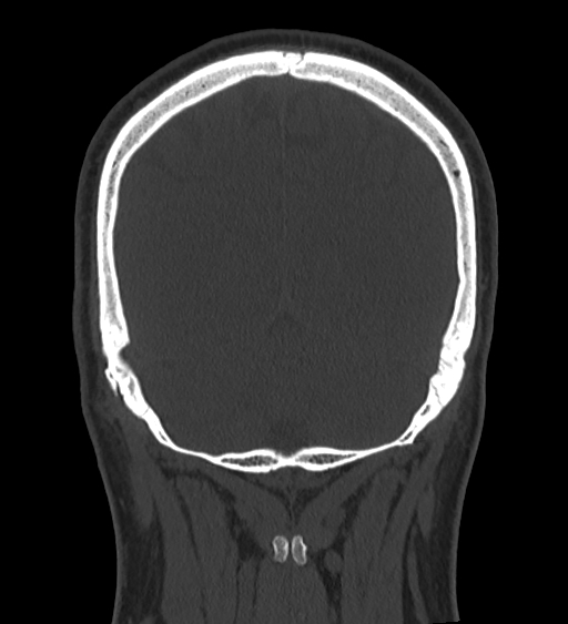 Occipital spur and Currarino type A atlas anomaly (Radiopaedia 87027-103285 Coronal bone window 115).jpg