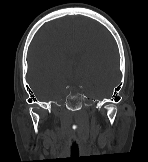 Occipital spur and Currarino type A atlas anomaly (Radiopaedia 87027-103285 Coronal bone window 79).jpg