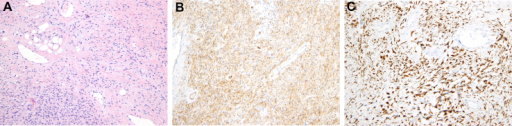 a)Mammary-type myofibroblastoma b) positive for CD34 c) and desmin