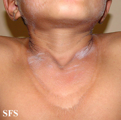 File:Pellagra (Dermatology Atlas 32).jpg