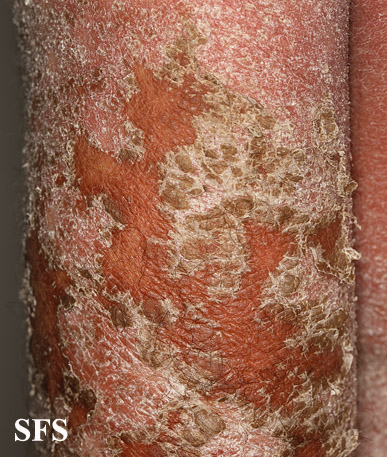 File:Psoriasis (Dermatology Atlas 76).jpg