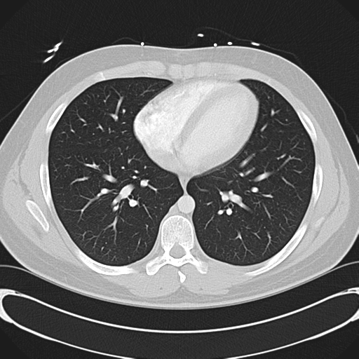 'Bovine' aortic arch (Radiopaedia 33554-34637 Axial lung window 40).png