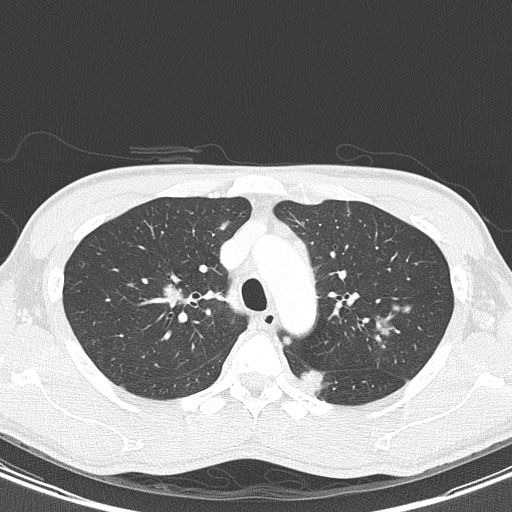 AIDS-related Kaposi sarcoma (Radiopaedia 85247-100811 Axial lung window 46).jpg