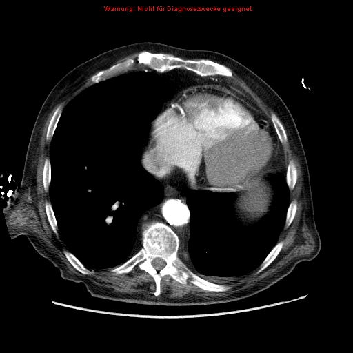File:Abdominal aortic aneurysm- extremely large, ruptured (Radiopaedia 19882-19921 Axial C+ arterial phase 4).jpg