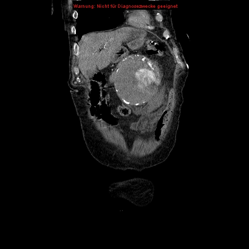 Abdominal aortic aneurysm- extremely large, ruptured (Radiopaedia 19882-19921 Coronal C+ arterial phase 21).jpg