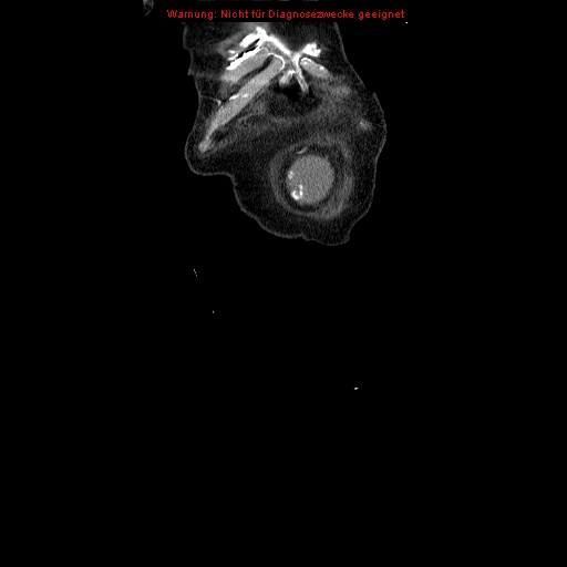 Abdominal aortic aneurysm- extremely large, ruptured (Radiopaedia 19882-19921 Coronal C+ arterial phase 5).jpg