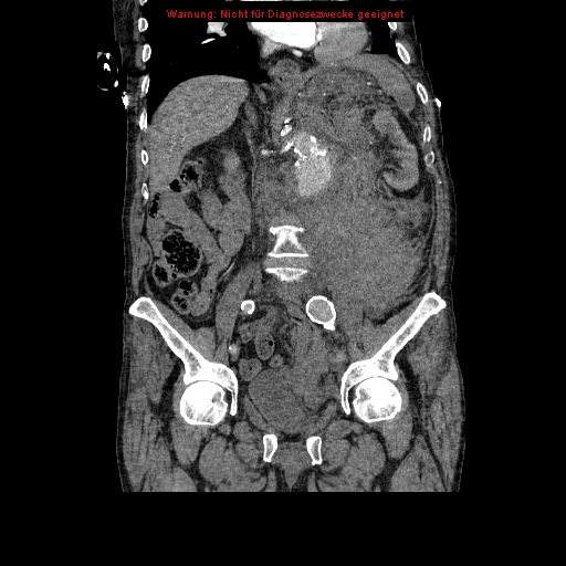 Abdominal aortic aneurysm- extremely large, ruptured (Radiopaedia 19882-19921 Coronal C+ arterial phase 55).jpg