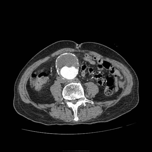 Abdominal aortic aneurysm (Radiopaedia 13341-13340 Axial C+ arterial phase 129).jpg