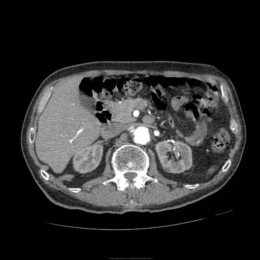 Abdominal aortic aneurysm (Radiopaedia 13341-13340 Axial C+ arterial phase 65).jpg