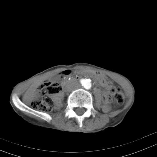 File:Abdominal aortic aneurysm (Radiopaedia 20827-20742 Axial C+ arterial phase 21).jpg