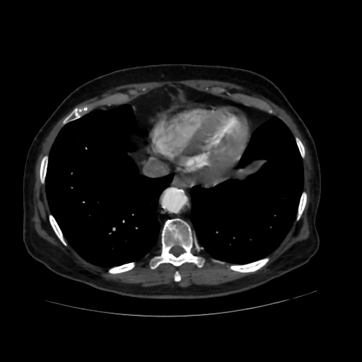 File:Abdominal aortic aneurysm (Radiopaedia 57318-64259 Axial C+ arterial phase 4).jpg