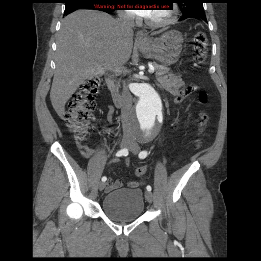 Abdominal aortic aneurysm (Radiopaedia 8190-9038 Coronal C+ arterial phase 60).jpg