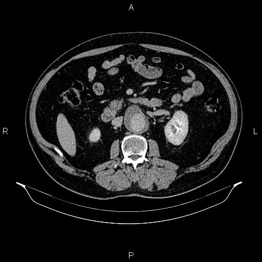 Abdominal aortic aneurysm (Radiopaedia 83094-97462 Axial renal excretory phase 47).jpg