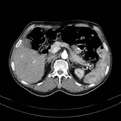 Abdominal aortic aneurysm (Radiopaedia 83581-98689 Axial C+ arterial phase 40).jpg