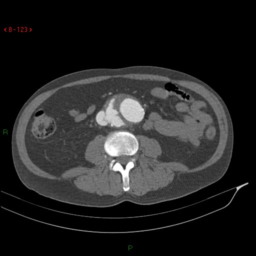 Abdominal aortic aneurysm rupture with aortocaval fistula (Radiopaedia 14897-14841 Axial C+ arterial phase 123).jpg