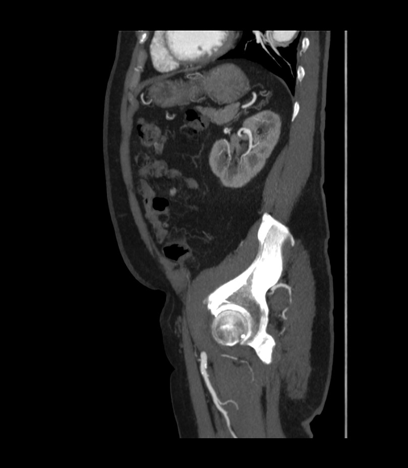 Abdominal aortic aneurysm with thrombus fissuration (Radiopaedia 46218-50618 Sagittal C+ arterial phase 44).jpg