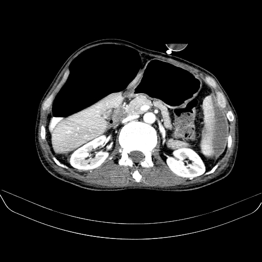 File:Abdominal collection due to previous cecal perforation (Radiopaedia 80831-94320 Axial C+ portal venous phase 74).jpg
