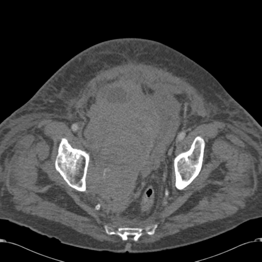 Abdominal hematoma (Radiopaedia 33614-34715 Axial C+ portal venous phase 116).png
