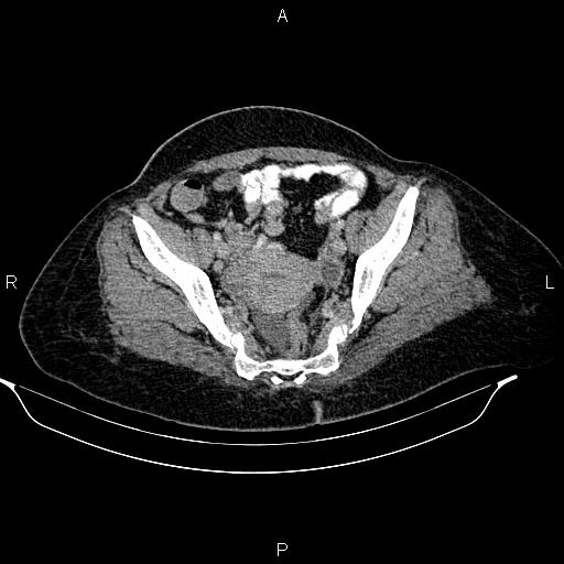 Abdominal lymphoma with sandwich sign (Radiopaedia 84378-99704 Axial C+ portal venous phase 48).jpg