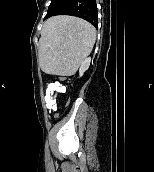 Abdominal lymphoma with sandwich sign (Radiopaedia 84378-99704 Sagittal C+ portal venous phase 76).jpg