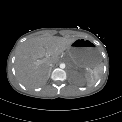 File:Abdominal multi-trauma - devascularised kidney and liver, spleen and pancreatic lacerations (Radiopaedia 34984-36486 Axial C+ arterial phase 86).png