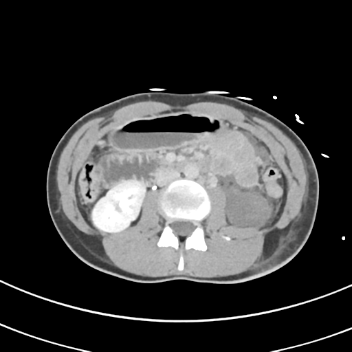 File:Abdominal multi-trauma - devascularised kidney and liver, spleen and pancreatic lacerations (Radiopaedia 34984-36486 Axial C+ delayed 36).png