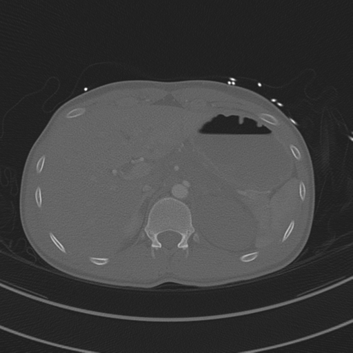 File:Abdominal multi-trauma - devascularised kidney and liver, spleen and pancreatic lacerations (Radiopaedia 34984-36486 I 89).png