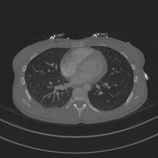 Abdominal multi-trauma - devascularised kidney and liver, spleen and pancreatic lacerations (Radiopaedia 34984-36486 Sagittal bone window 1).png