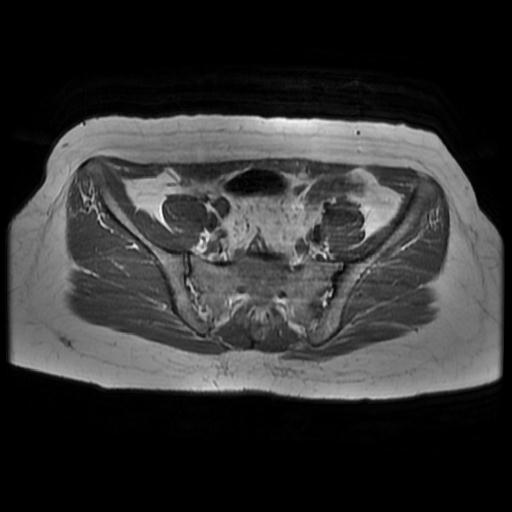 File:Abdominal wall endometriosis (Radiopaedia 83702-98847 Axial T1 4).jpg