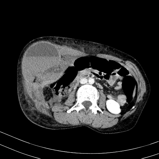 Abdominal wall hematoma with active bleeding (Radiopaedia 83915-99122 Axial contrast-enhanced CT 18).jpg