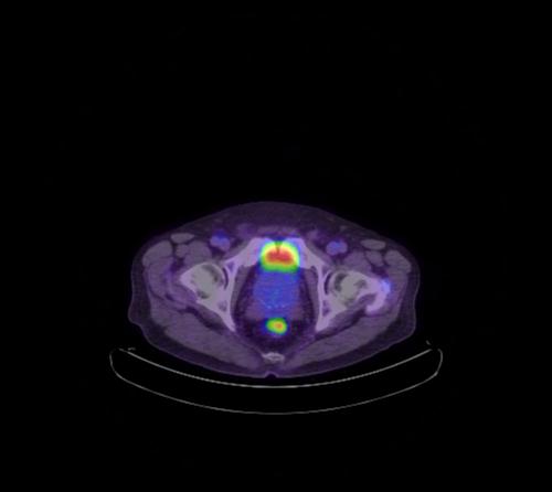 Abdominal wall metastasis from colorectal carcinoma (Radiopaedia 31016-31719 Axial 24).jpg