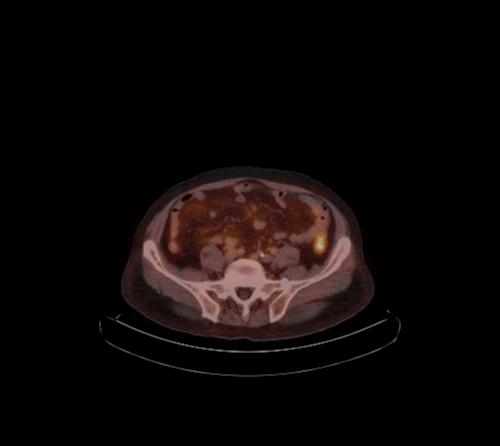 Abdominal wall metastasis from colorectal carcinoma (Radiopaedia 31016-31719 C 45).jpg