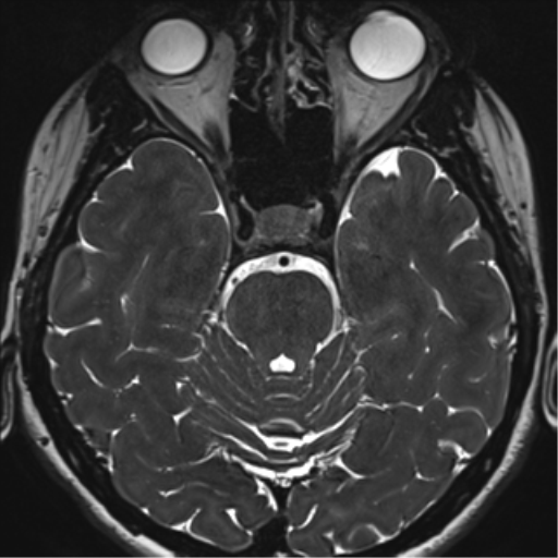 Abducens nerve palsy (Radiopaedia 51069-56648 Axial T2 fat sat 47).png