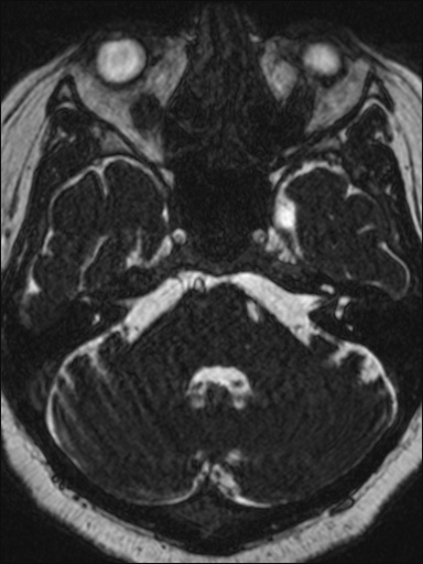 File:Abducens nerve palsy (Radiopaedia 57084-63976 Axial T2 ciss 3d 27).jpg