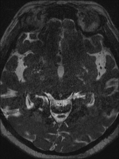 Abducens nerve palsy (Radiopaedia 57084-63976 Axial T2 ciss 3d 64).jpg
