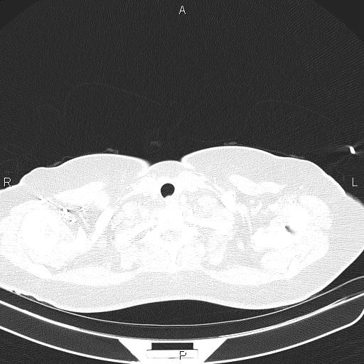Aberrant right subclavian artery (Radiopaedia 87334-103629 Axial lung window 7).jpg