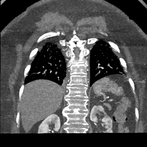 File:Aberrant right subclavian artery with Kommerell diverticulum (Radiopaedia 47982-52769 Coronal C+ arterial phase 63).png