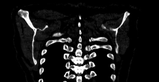 Accesory rib joint (Radiopaedia 71987-82452 Coronal bone window 76).jpg