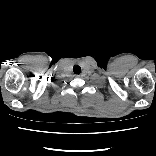 Accessory left horizontal fissure with lingular pneumonia (Radiopaedia 53763-59843 Axial C+ CTPA 2).jpg