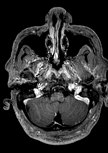 Accessory middle cerebral artery (Radiopaedia 73114-83828 Axial T1 C+ 158).jpg